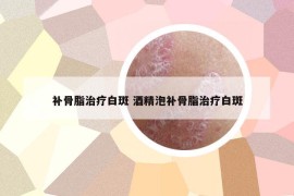 补骨脂治疗白斑 酒精泡补骨脂治疗白斑