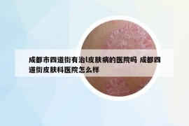 成都市四道街有治l皮肤病的医院吗 成都四道街皮肤科医院怎么样