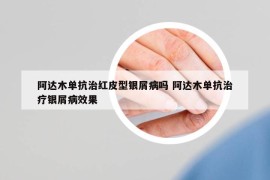 阿达木单抗治红皮型银屑病吗 阿达木单抗治疗银屑病效果