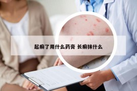 起癣了用什么药膏 长癣抹什么