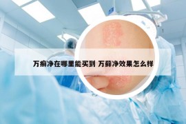 万癣净在哪里能买到 万藓净效果怎么样