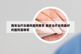 西安治疗白癜风医院那家 西安治疗白斑最好的医院是哪家