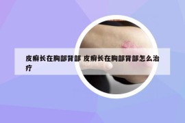 皮癣长在胸部背部 皮癣长在胸部背部怎么治疗