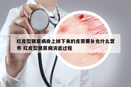 红皮型银屑病身上掉下来的皮需要补充什么营养 红皮型银屑病消退过程