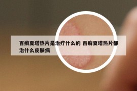 百癣夏塔热片是治疗什么的 百癣夏塔热片都治什么皮肤病