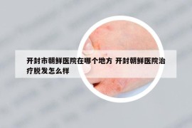 开封市朝鲜医院在哪个地方 开封朝鲜医院治疗脱发怎么样