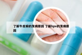 了解牛皮癣的发病原因 了解hpv的发病原因