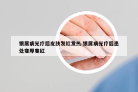 银屑病光疗后皮肤发红发热 银屑病光疗后患处变厚变红