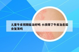 儿童牛皮初期能治好吗 小孩得了牛皮治愈后会复发吗