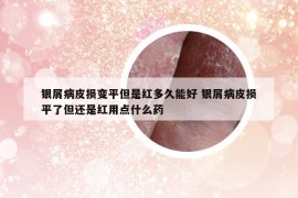 银屑病皮损变平但是红多久能好 银屑病皮损平了但还是红用点什么药