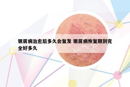 银屑病治愈后多久会复发 银屑病恢复期到完全好多久