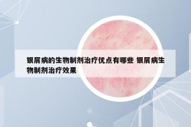 银屑病的生物制剂治疗优点有哪些 银屑病生物制剂治疗效果