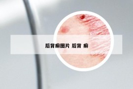 后背癣图片 后背 癣