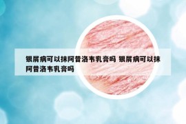 银屑病可以抹阿昔洛韦乳膏吗 银屑病可以抹阿昔洛韦乳膏吗