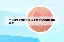 小孩得牛皮鲜吃什么药 儿童牛皮鲜最佳治疗方法