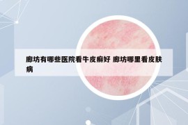 廊坊有哪些医院看牛皮癣好 廊坊哪里看皮肤病