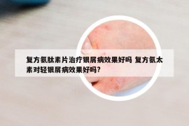 复方氨肽素片治疗银屑病效果好吗 复方氨太素对轻银屑病效果好吗?