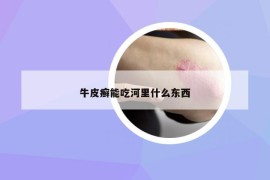 牛皮癣能吃河里什么东西