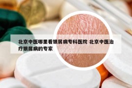 北京中医哪里看银屑病专科医院 北京中医治疗银屑病的专家