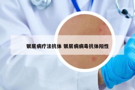 银屑病疗法抗体 银屑病病毒抗体阳性