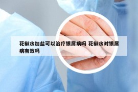 花椒水加盐可以治疗银屑病吗 花椒水对银屑病有效吗