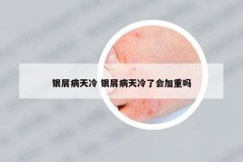 银屑病天冷 银屑病天冷了会加重吗