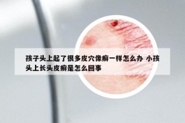 孩子头上起了很多皮穴像癣一样怎么办 小孩头上长头皮癣是怎么回事