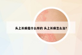 头上长癣是什么样的 头上长癣怎么治?