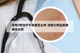 沈阳7院治疗牛皮癣怎么样 沈阳七院治皮肤病怎么样