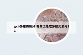 gxb多维白癜风 有白斑能吃多维元素片21