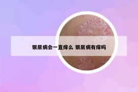 银屑病会一直痒么 银屑病有痒吗