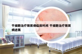 干细胞治疗银屑病临床时间 干细胞治疗银屑病进展