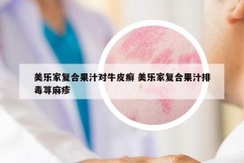 美乐家复合果汁对牛皮癣 美乐家复合果汁排毒荨麻疹