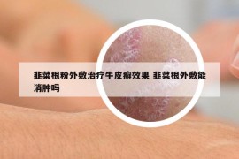 韭菜根粉外敷治疗牛皮癣效果 韭菜根外敷能消肿吗