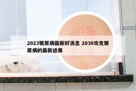 2023银屑病最新好消息 2030攻克银屑病的最新进展