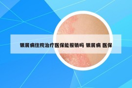 银屑病住院治疗医保能报销吗 银屑病 医保