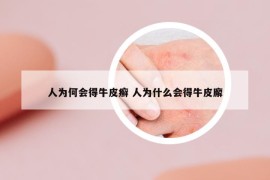 人为何会得牛皮癣 人为什么会得牛皮廨