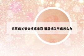 银屑病关节炎疼痛难忍 银屑病关节痛怎么办