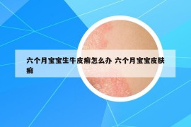 六个月宝宝生牛皮癣怎么办 六个月宝宝皮肤癣