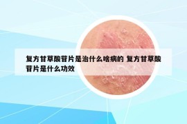 复方甘草酸苷片是治什么啥病的 复方甘草酸苷片是什么功效