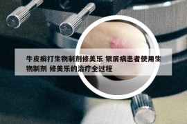 牛皮癣打生物制剂修美乐 银屑病患者使用生物制剂 修美乐的治疗全过程