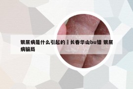 银屑病是什么引起的來长春华山bu错 银屑病骗局