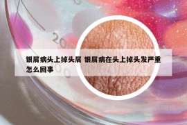 银屑病头上掉头屑 银屑病在头上掉头发严重怎么回事