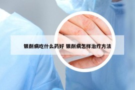 银削病吃什么药好 银削病怎样治疗方法