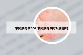 掌跖脓疱病360 掌跖脓疱病可以自愈吗