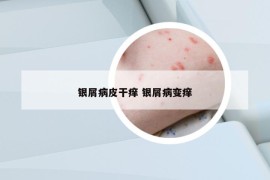 银屑病皮干痒 银屑病变痒