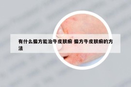 有什么偏方能治牛皮肤癣 偏方牛皮肤癣的方法