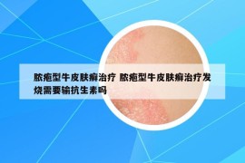 脓疱型牛皮肤癣治疗 脓疱型牛皮肤癣治疗发烧需要输抗生素吗