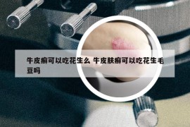 牛皮癣可以吃花生么 牛皮肤癣可以吃花生毛豆吗