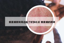 银屑病斑块周边起了好多红点 银屑病的斑块